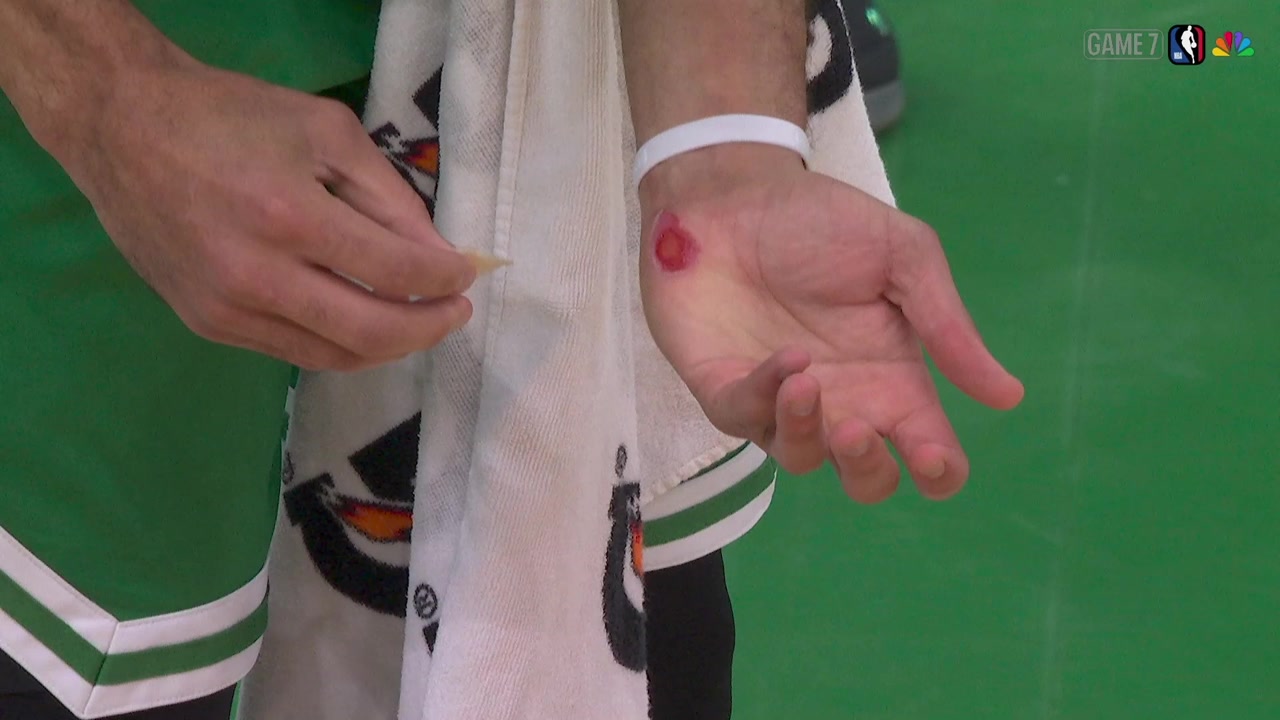 Derrick White lost some of his skin on his wrist and he tries to cool the area down